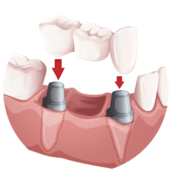 remplacer plusieurs dents par un implant 