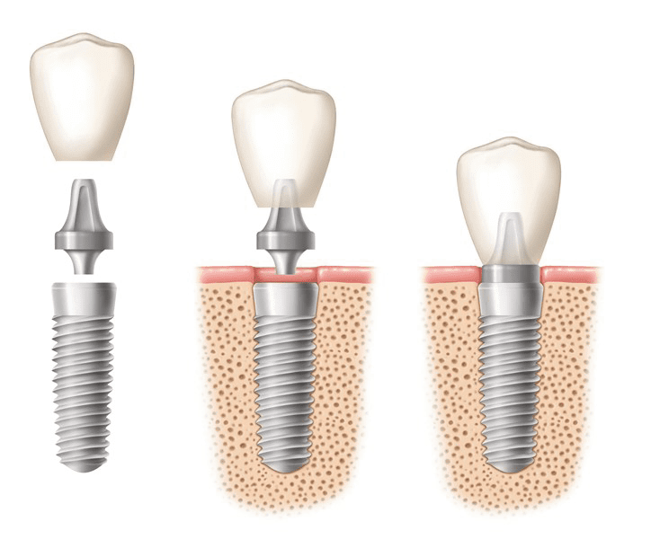 Schéma implant dentaire