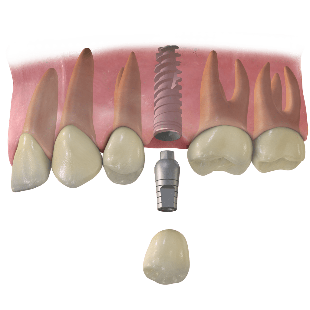 schéma remplacement d'une seule dent par un implant dentaire