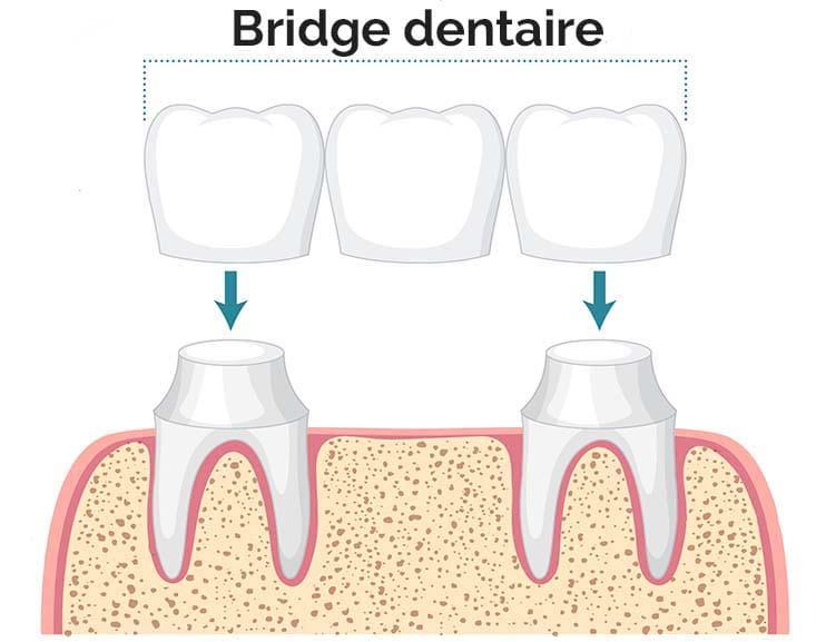 Schéma d'un bridge dentaire