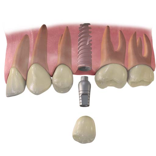 remplacer une seule dent par un implant